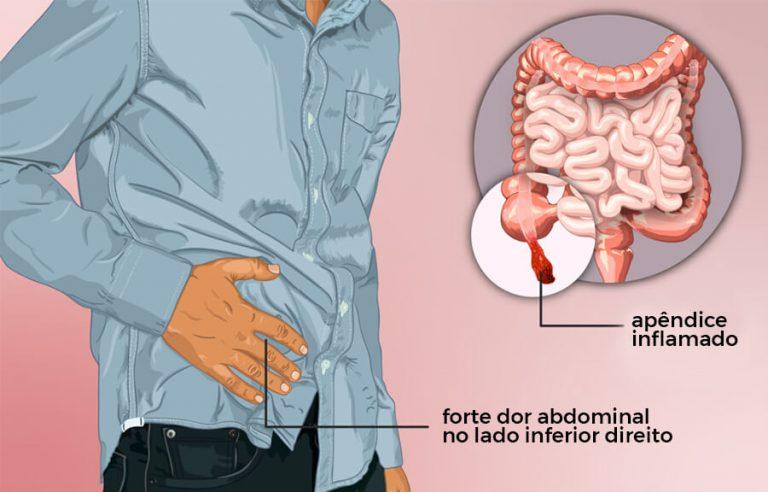 Apendicite Causas Sintomas Tratamento E Cirurgia Hc Imagem 6825