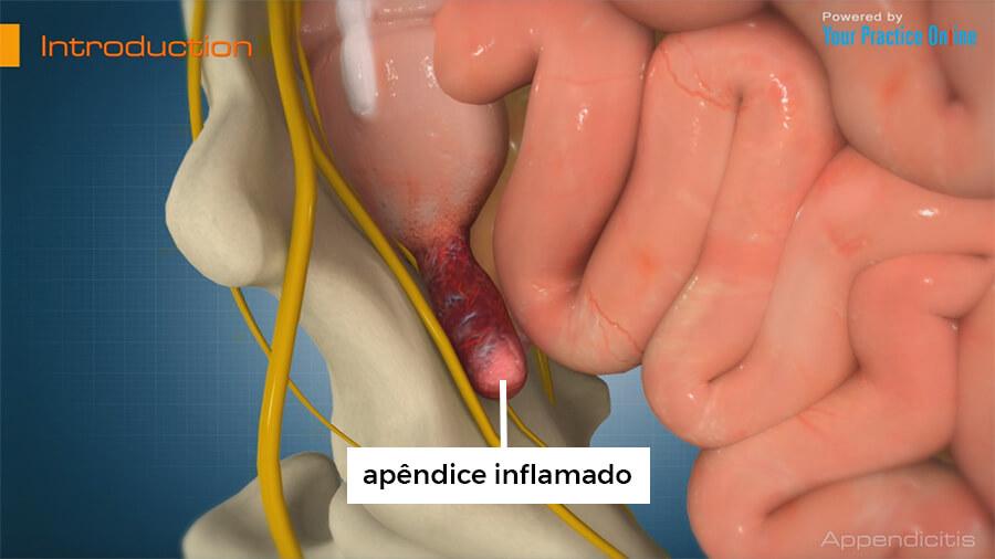 apêndice inflamado